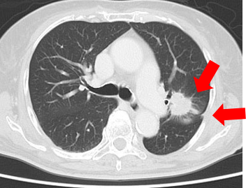 肺癌が疑われる患者さんの肺の写真