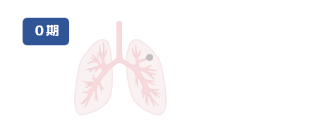 ステージ0の肺の例（イラスト）