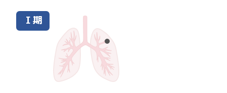 ステージ1の肺の例（イラスト）