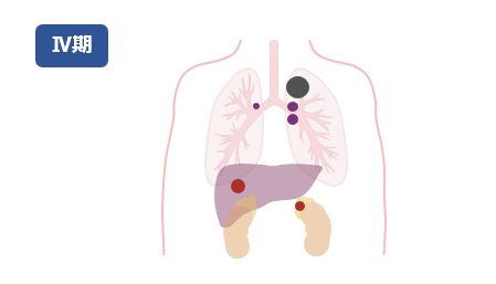 ステージ4の肺の例（イラスト）