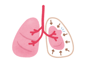 気胸時の肺の図