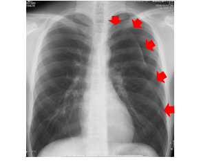 自然気胸患者の胸部レントゲン写真