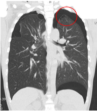 肺嚢胞(ブラ)の画像