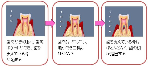 歯周病の進行図