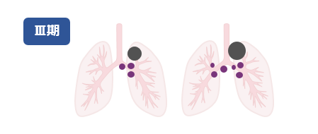ステージ3の肺の例（イラスト）