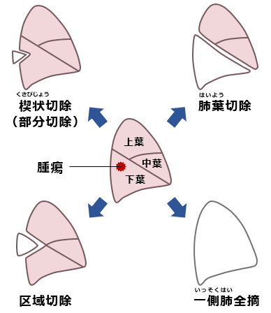 肺癌の術式に関する図（楔状切除、肺葉切除、区域切除、一側肺全摘）