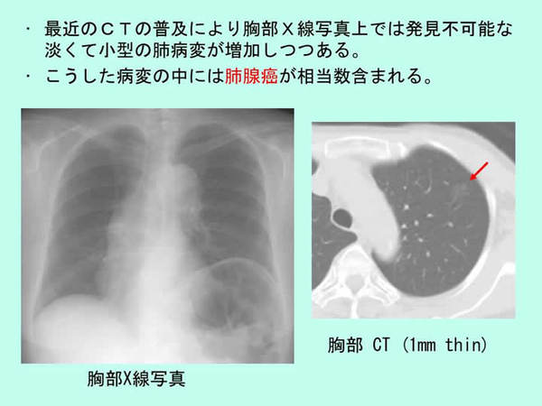 胸部CT、X線写真